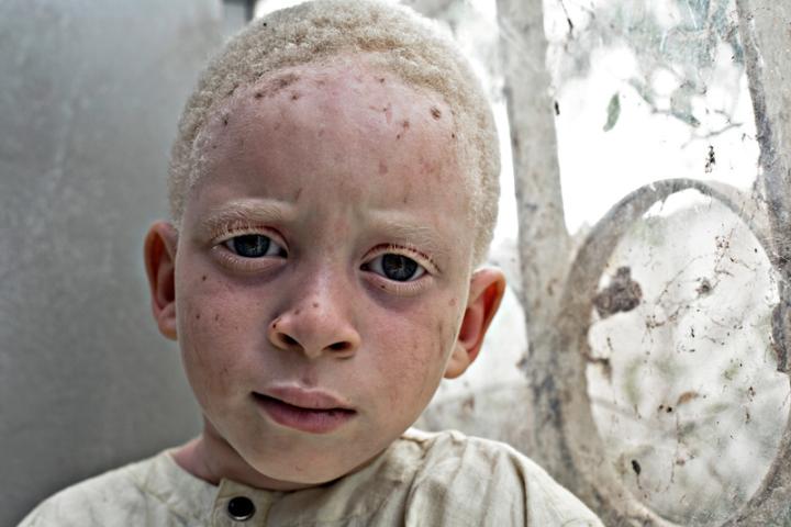 Casa África muestra la realidad de la vida de los albinos en Senegal con una exposición fotográfica