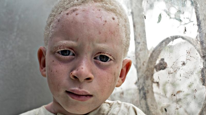 Casa África muestra la realidad de la vida de los albinos en Senegal con una exposición fotográfica