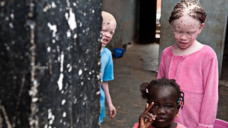 Casa África muestra la realidad de la vida de los albinos en Senegal con una exposición fotográfica