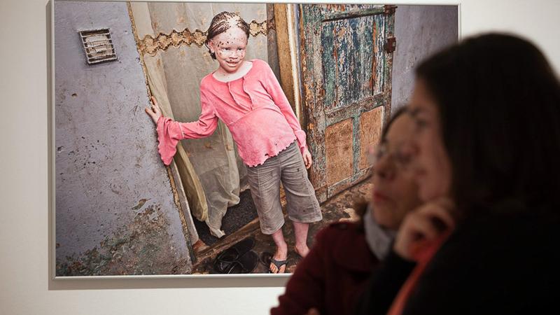 Casa África muestra la realidad de la vida de los albinos en Senegal con una exposición fotográfica