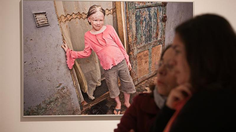 3. Exposición Albinos, a la sombra del sol, en Casa África